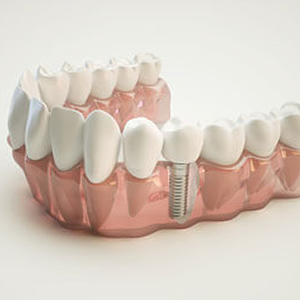 Illustration of dental implant