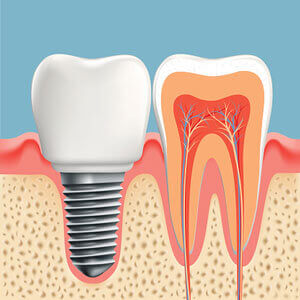 cross section of tooth with implant