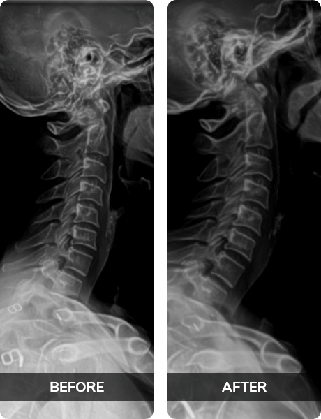 before and after x-ray scans