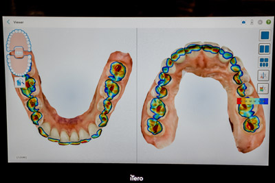 Invisalign illustration