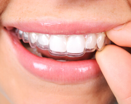 Female patent fitting Invisalign