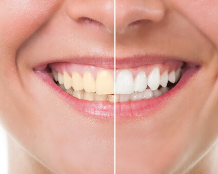 teeth whitening process