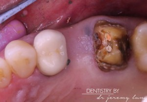 16 Old crown removed