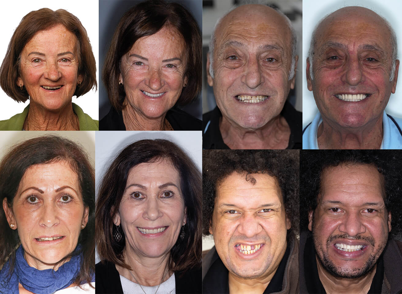 Patient before and after smile transformations