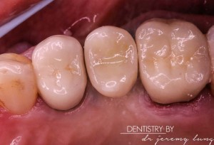 Completed case with new crown 16 and implant 15