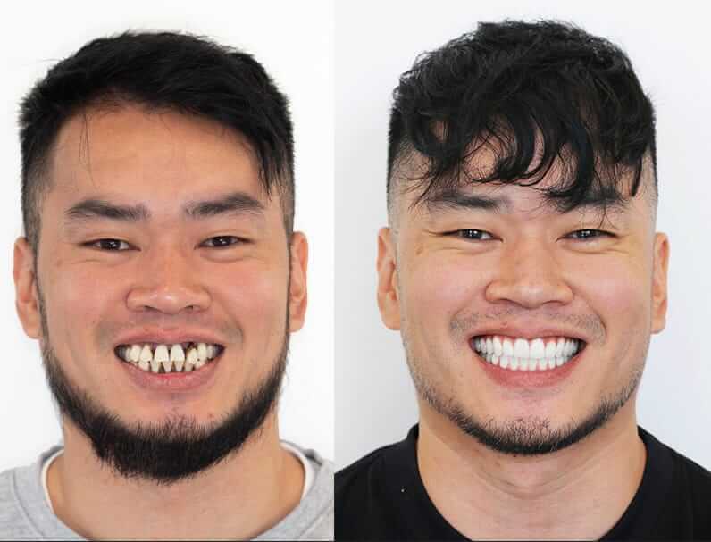 Patient smiling after dental implant treatment at Epping Family Dental