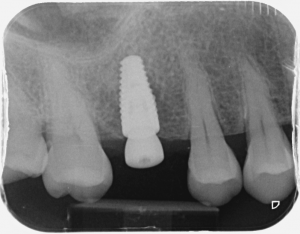X-ray showing good implant