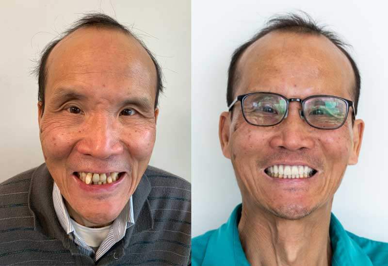 Kent — before and after All-on-X dental implant treatment