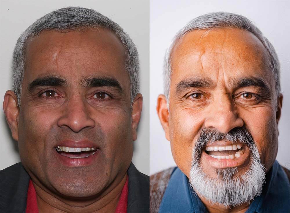 Ivan — before and after full upper All-on-X treatment
