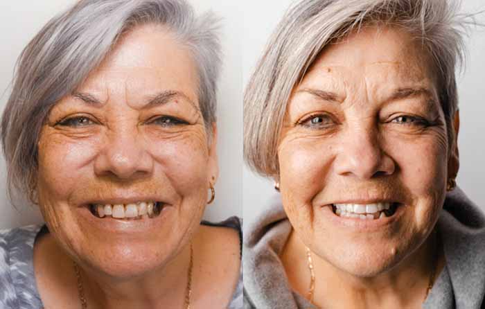 Robyn — before and after full upper All-on-6 zirconia bridge
