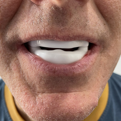 close up of man with dental snoring device
