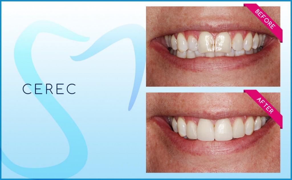 cerec before and after