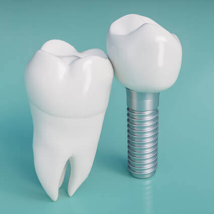 standing-model-of-tooth-with-dental-implant-sq