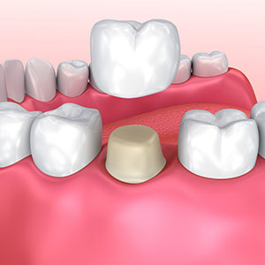 Dental Crown Illustration