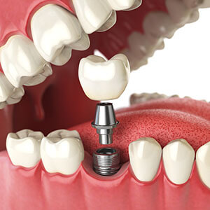 Dental Implant Illustration