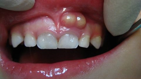 abscessed tooth drainage