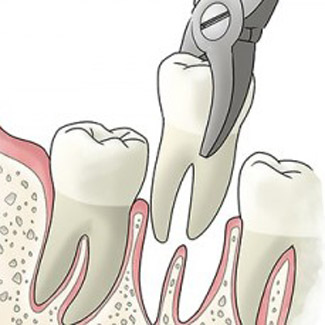 tooth extraction illustration
