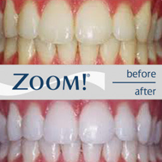 zoom teeth whitening before and after images