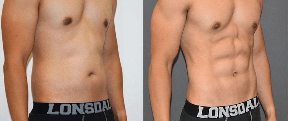 Emsculpt for Men: Six-Pack Abs By Way of Body Contouring