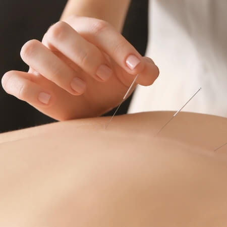 Patient treated with acupuncture on back