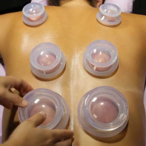 Cupping at Cookstown Chiropractic & Wellness Centre