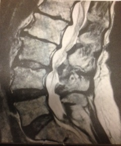 Spinal Stenosis