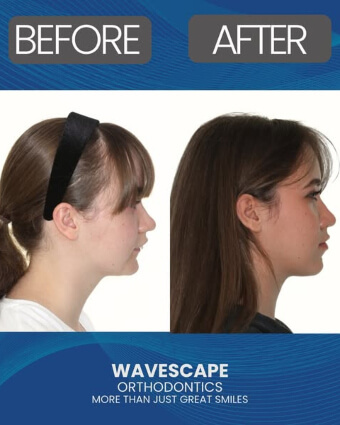 Alexea before and after profile