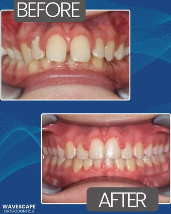 Alexea teeth front