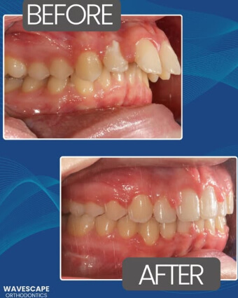 Alexea teeth side