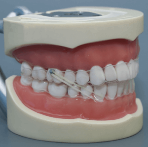 How to Wear Your Class III Elastics