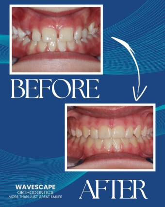 Greta before and after teeth