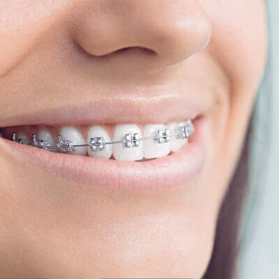 beautiful braces