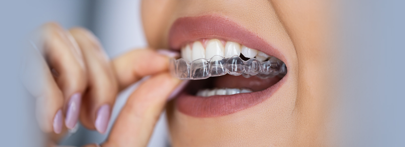 Woman inserting clear aligners