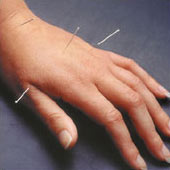 Acupuncture in West Lafayette is effective!