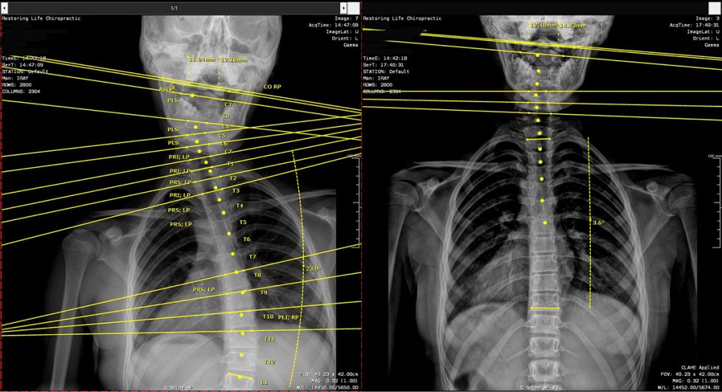 Xray of scoliosis before and after