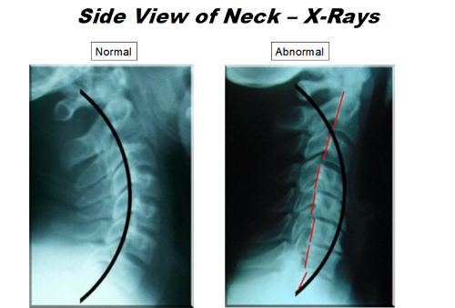 postural-correction-xray