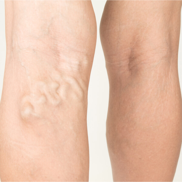 varicose vein