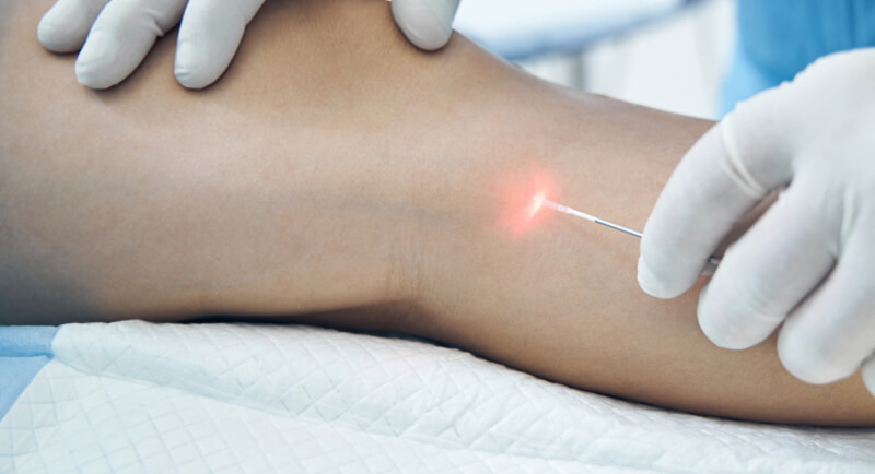 img-varicose-veins-treatment