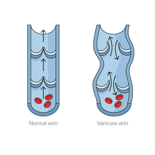 Normal Vein vs Varicose vein
