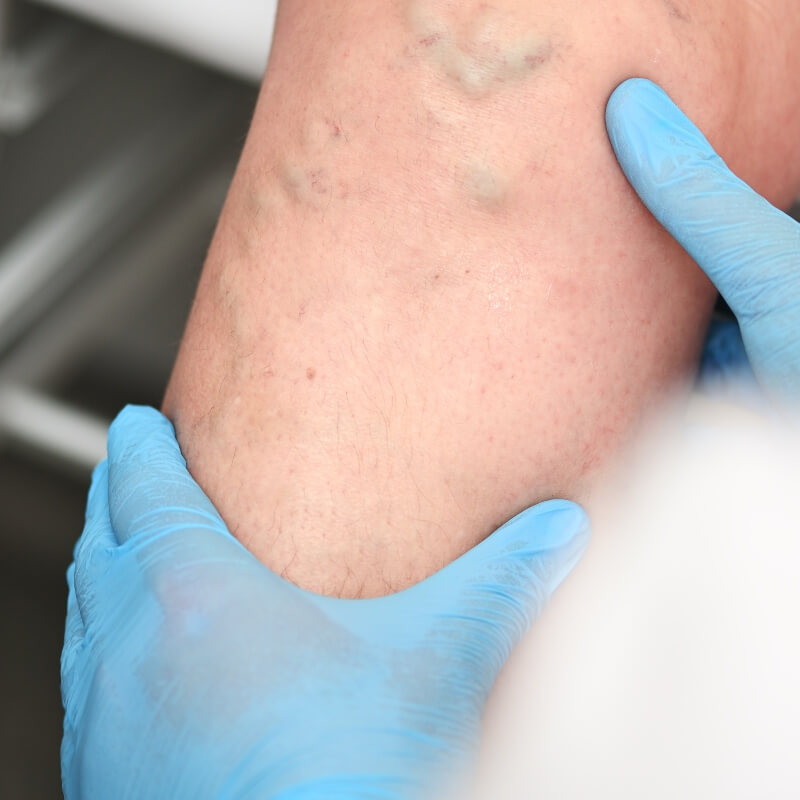 doctor looking at varicose veins