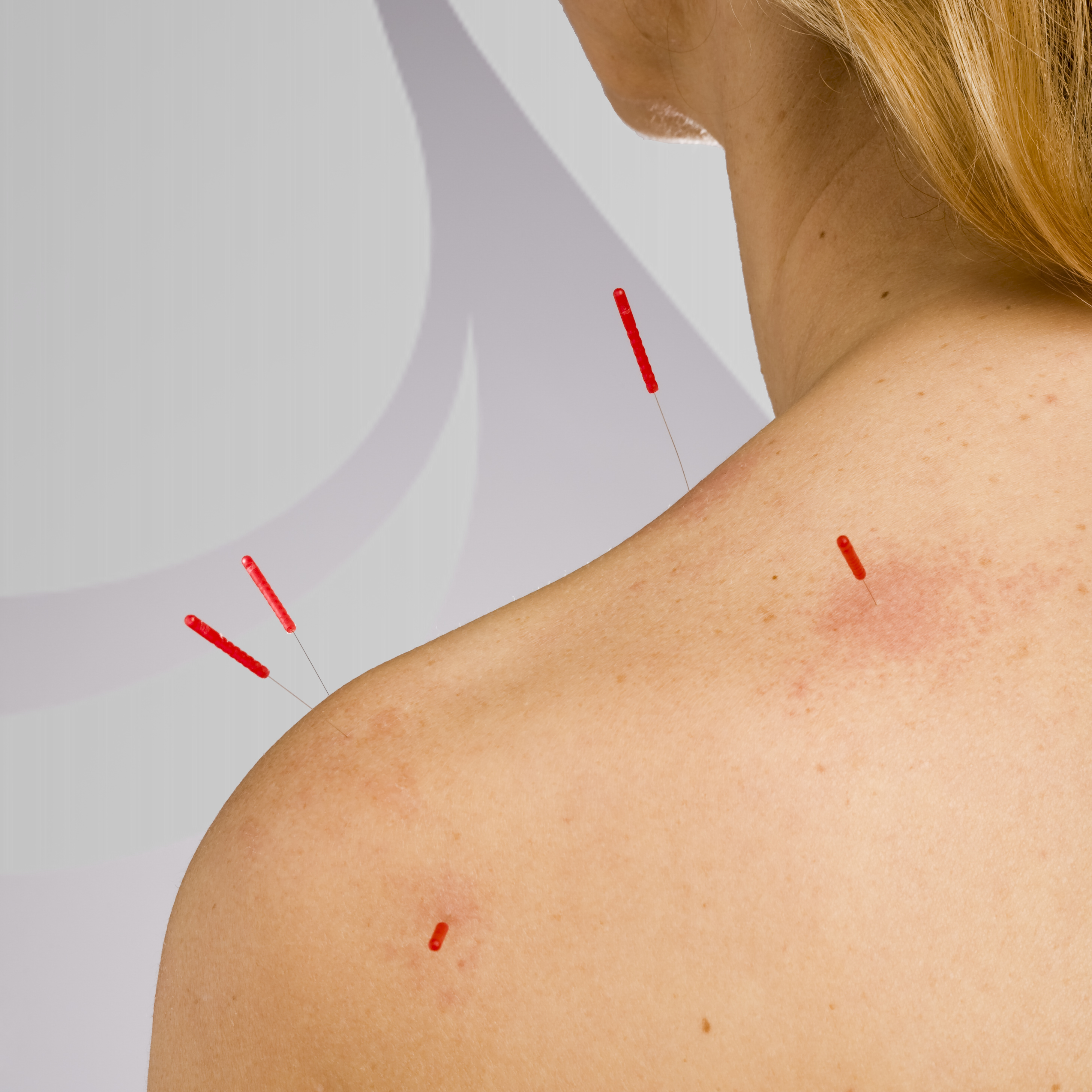 Discovering Acupuncture Batson ChiroHealth Group