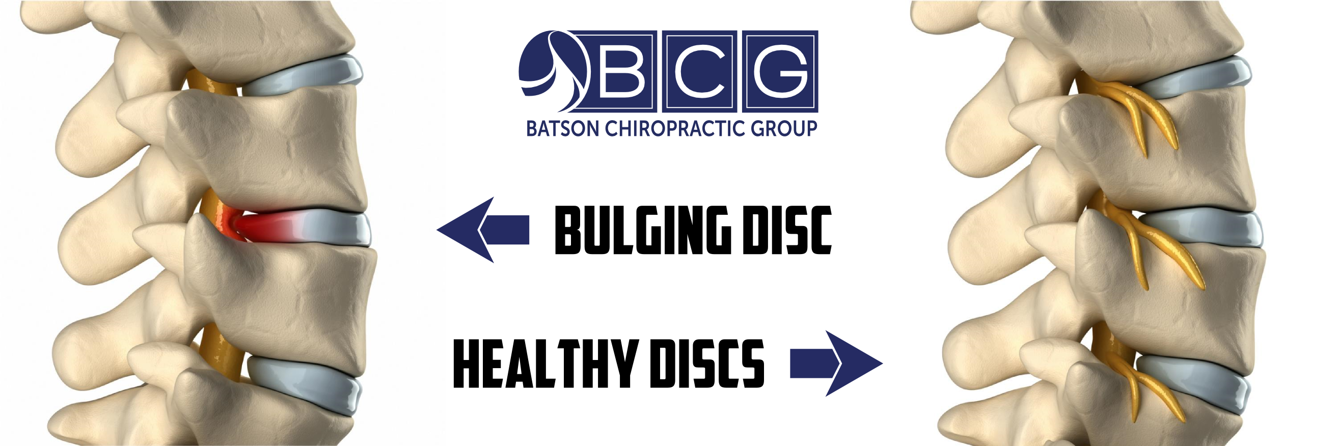 bulging-discs-symptoms-and-treatment-discectomy