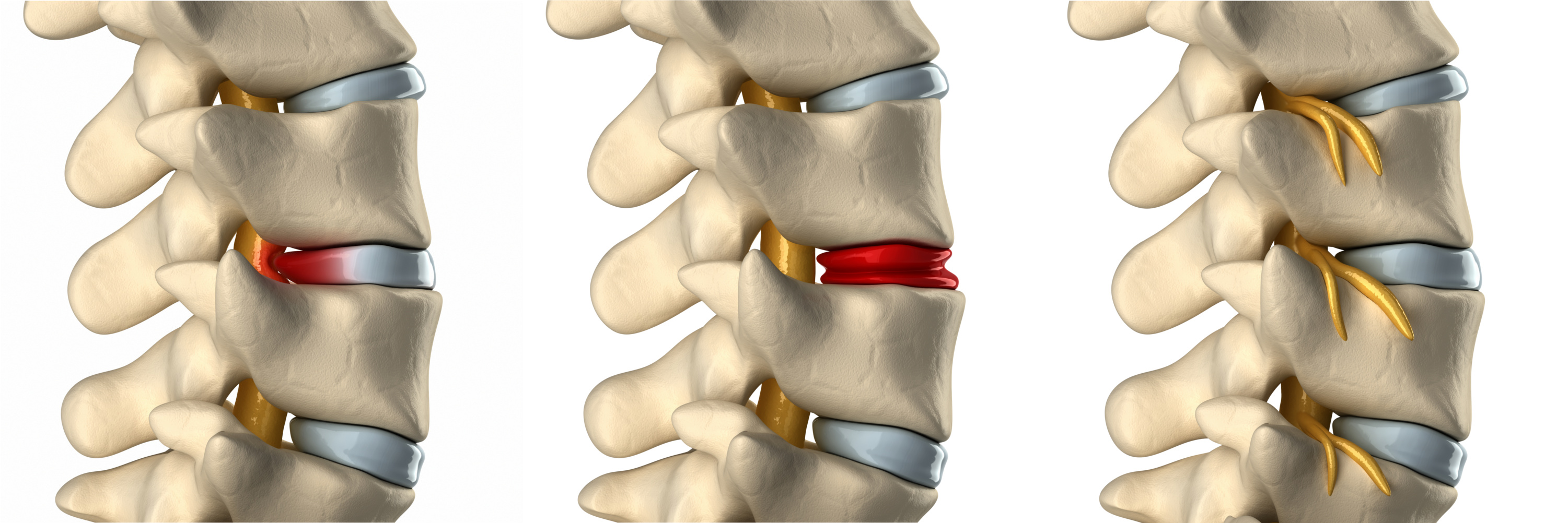 Herniated Discs Pinched Nerves And Bulging Discs Batson Chirohealth