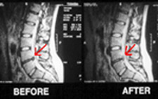 Getting results with Nashville spinal decompression