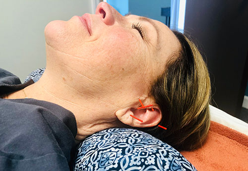 Photo of a patient with acupuncture needs in their ear