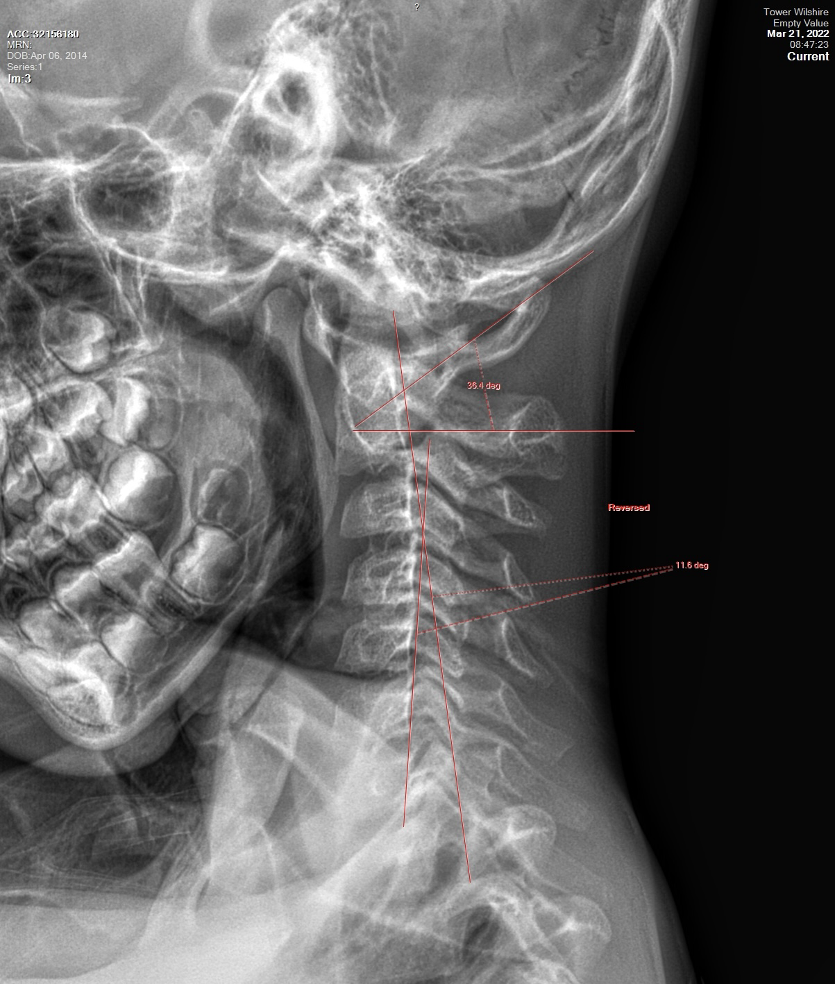 Xray Image of Skull