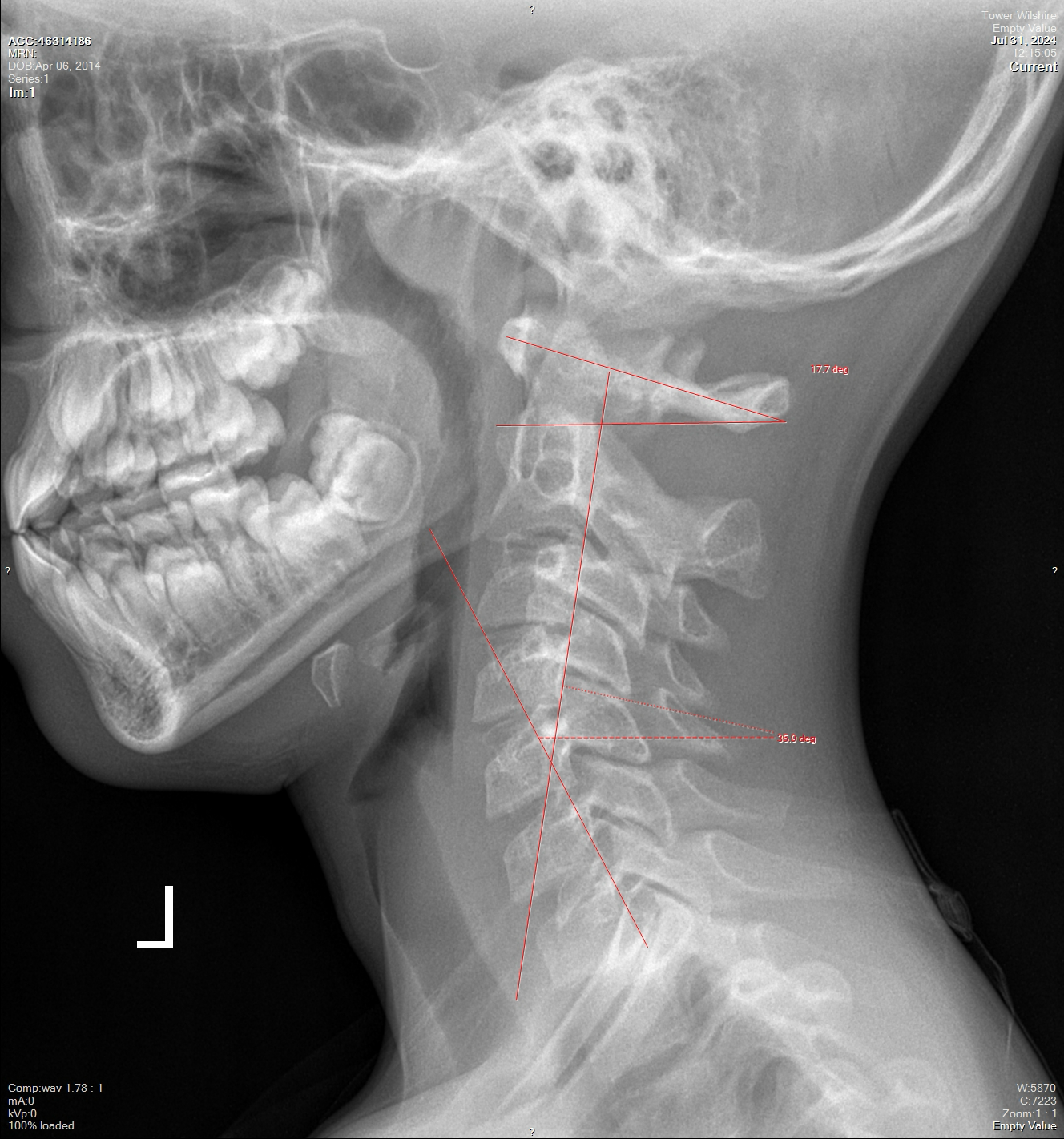 Xray Image of Skull