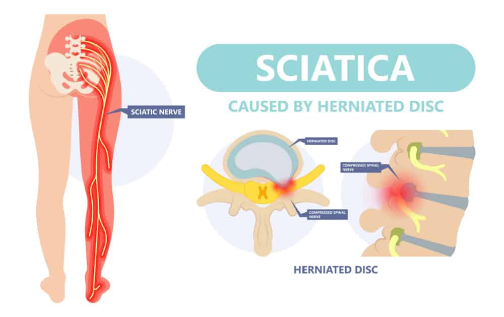 herniated disc and sciatica