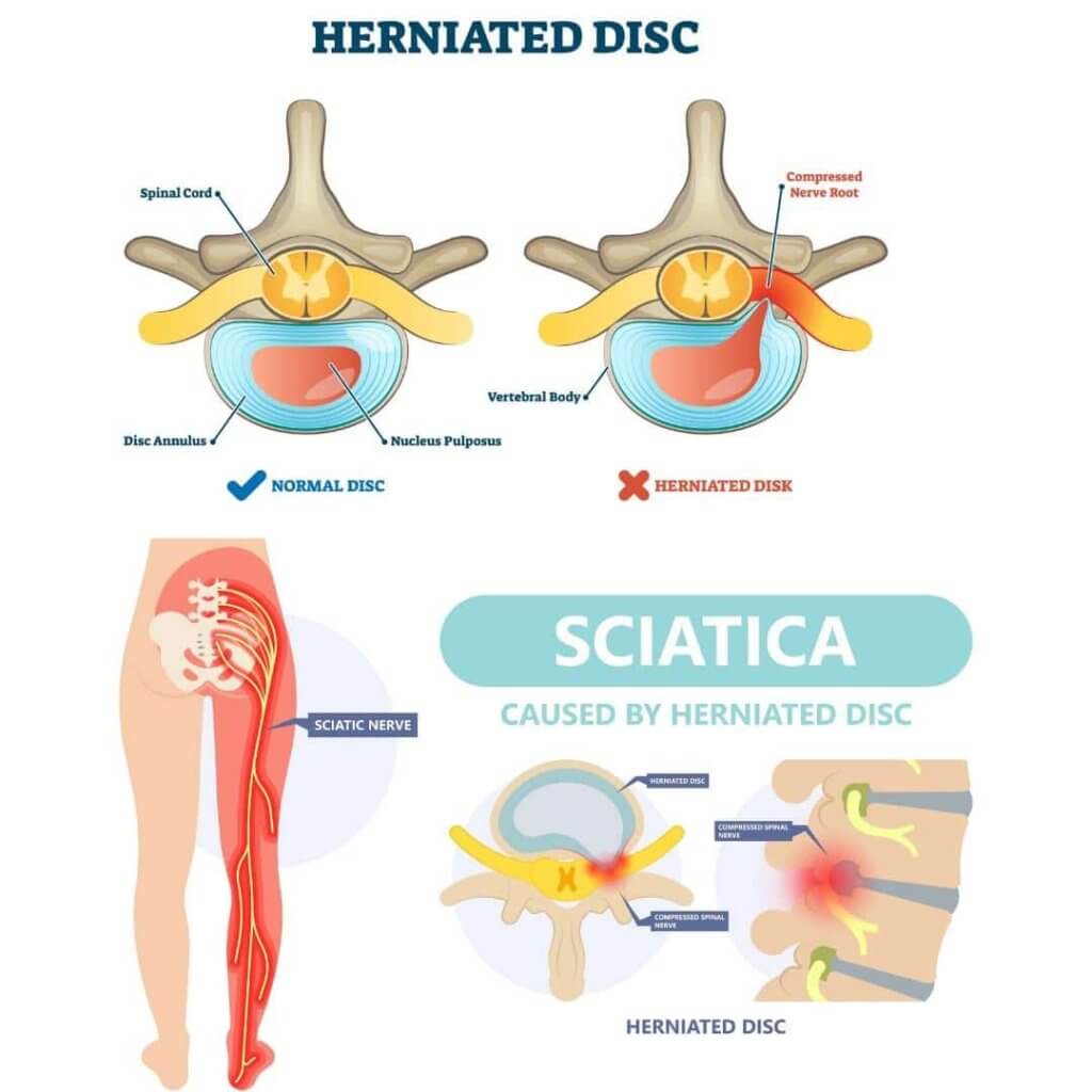 herniated disc 