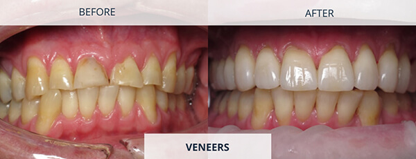 Cracked-Or-Worn-Teeth-Veneers